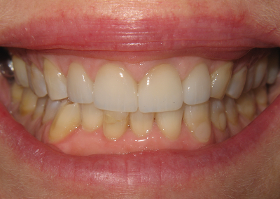 Smile Gallery - After